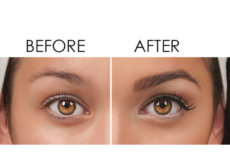 Wat Is het Verschil tussen PRP en Wenkbrauwtransplantatie? Welke Is Duurzamer?