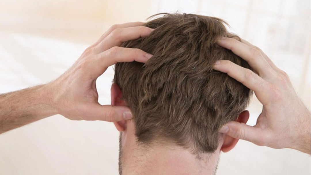  Is Jeuk na een Haartransplantatie Normaal? Wanneer Verdwijnt het?